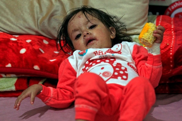 A Yemeni child receives treatment for measles Sanaa, Yemen on March 21, 2021. (Photo by MOHAMMED HUWAIS/AFP via Getty Images) A Yemeni child receives treatment for measles Sanaa, Yemen on March 21, 2021. (Photo by MOHAMMED HUWAIS/AFP via Getty Images)