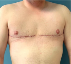 A transgender "man" (biological woman) who has had her breasts surgically removed. (Screenshot)
