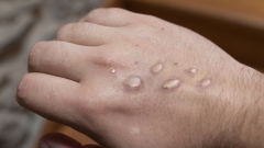 Monkeypox. (Getty Images)